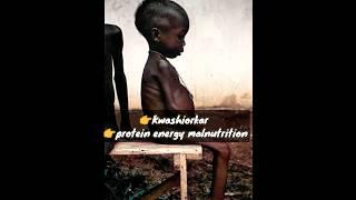 Kwashiorkor- Severe Deficiency of Protein #mbbs #next