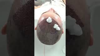 #hairtransplant #hair #longhair #longhaircenter #hairtransformation #hairtransplantationturkey