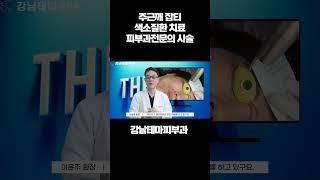 잡티 흑자 주근깨 색소질환치료 피부과전문의 시술 왜 다를까요? #잡티#흑자