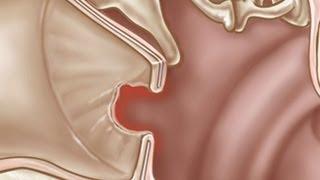 How to Treat a Perforated Ear Drum | Ear Problems