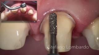 Chamfer vs BOPT: Lithium Disilicate adhesive crowns, by Stefano Lombardo