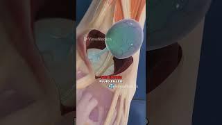 Ganglion Cyst Removal (3D Animation)