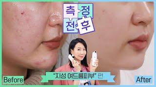 (*Eng) 2달 동안 구독자님 피부 고민 해결함!!?  민감 지성 스킨케어 루틴 Do& Don't by 디렉터파이