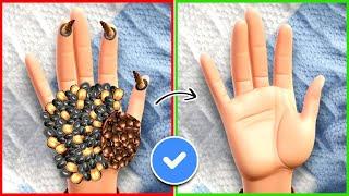 ASMR Remove Dog Ticks & Maggots From Hand | Severely Injured Treatment Animation