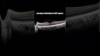 Retinal layers in OCT #eyecareprofessional #shorts #viralvideo #educational #explore #trending