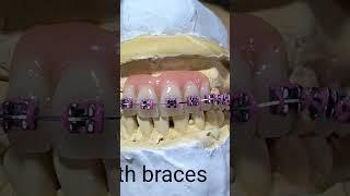 Dentures with braces, Retainer Like braces.