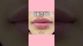 인중 짧아지는 러시안립필러 #입술컨설팅
