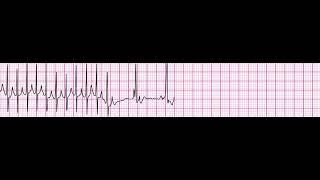 SVT Converting to NSR after Adenosine