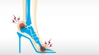 Easy Fixes For High Heel Pain, Arch Pain + Athlete's Foot | Dr. Brad From My Feet Are Killing Me