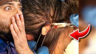 Popping huge blackheads and Giant Pimples- Best Pimple Popping Videos