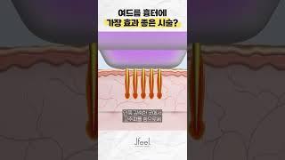 여드름 흉터 치료에 가장 좋은 시술! 직접 피부에 구멍을 뚫는다고? 