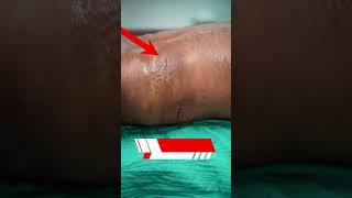 Lipoma | Lipoma Removal | Multipal Lipoma Removal #short #shortvideo