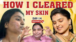 Day 14 | ACNE PRONE TO CLEAR SKIN | Secret Disclosed | #sankshitha #love #oppositesattract