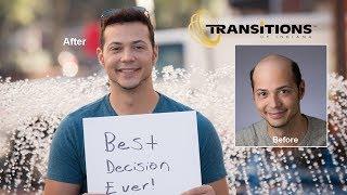 Best Hair Transplant Surgery Alternative - See Results