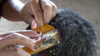 Wow Big Flakes In My Daddy's Hair !! Natural Dandruff Scratching Scalp #180