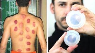 What The Heck is Cupping? | Traditional Chinese Medicine Cupping Therapy