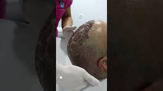 Saç ekimi sonrası 3.gün yıkaması #hairtransplant #saçekimi