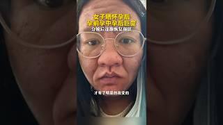 云南女子晒怀孕后孕前孕中孕后巨变，分娩后逐渐恢复颜值 #怀孕
