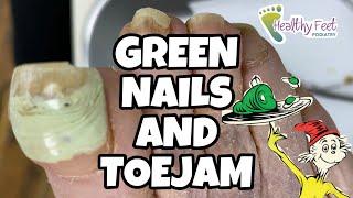 GREEN NAILS AND TOEJAM! CUTTING LONG, THICK, GREEN TOENAILS!