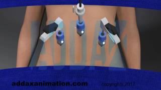 laproscopy procedure animation