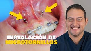 INSTALACIÓN de MICROTORNILLO en TRATAMIENTO de ORTODONCIA EXPLICADO