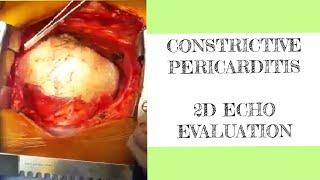 Constrictive pericarditis - 2D ECHO evaluation