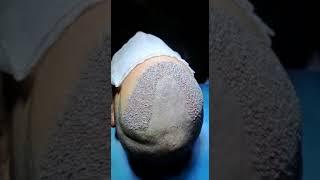 Hair transplant turkey #hairtransplantationturkey