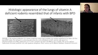 52in52 Journal Club - Vitamin A BPD 3-25-21