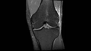 Iliotibial band (ITB) friction syndrome