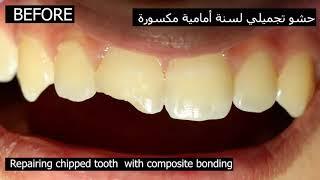 Chipped Front Tooth Repair | Dentist repair broken tooth with Composite Bonding