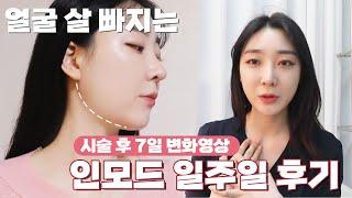 심부볼 이중턱 없애기! (인모드시술 일주일 후기!) 인모드fx・ 가격・통증・부작용・ 효과까지