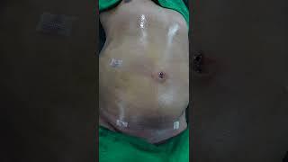 Male Abdomen Liposuction result #shorts