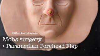 Playdough Surgery  - Mohs surgery and Paramedian Forehead Flap