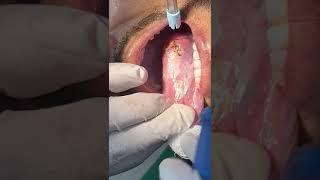 LEUKOPLAKIA REMOVAL