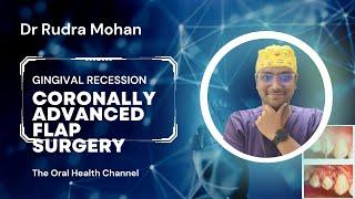 Dr Rudra Mohan | How to Manage Single tooth Gum Recessions? Coronally Advanced Flap Surgery (CAF)