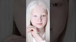 Albino Secrets: Rare Facts You Never Knew! #ytshorts #trending #viral