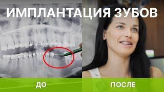 Имплантация зубов с расщеплением костной ткани: Кейс из Центра Имплантации Рица, Волжский