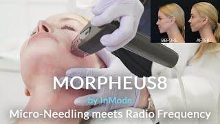 MORPHEUS8 by InMode; Micro-Needling meets Radio Frequency | Over 50