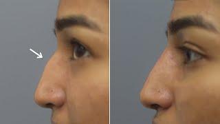 Nonsurgical rhinoplasty in India  | 15 minutes non surgical rhinoplasty at Cara clinic Mumbai.