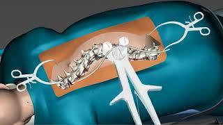 Spinal Curvature Surgery 3D