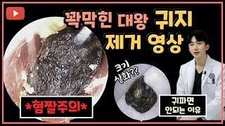 귀지/귓밥/귀똥 제거영상ㅣ귀파면 안되는 이유 (식사 전에는 보지마세요..)ear wax removal