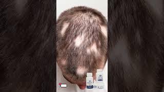 Cure Your Alopecia Areata within 3 Months with this Ayurvedic VHCA  Combo!