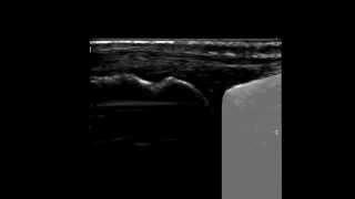 Musculoskeletal Ultrasound: Hand 1: dorsal longitudinal scan of MCP joint