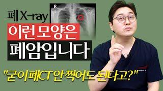 X-ray로 폐암을 찾은 사연 / 오늘의 환자