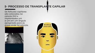 Transplante Capilar DHI