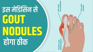 इस मेडिसिन से GOUT NODULES होगा ठीक | Dr. Kavita Soni | Soni Homeopathy clinic Bangalore