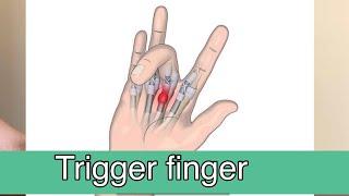 Trigger finger Exercise | House Physiotherapy