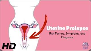 Uterine Prolapse: Treatment Options and Recovery Tips!