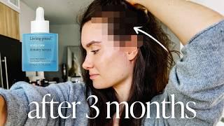 Unsponsored Living Proof Scalp Care Density Serum Review | 3 Month Update