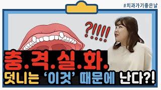 전국의 덧니인들 이것 좀 봐주라주